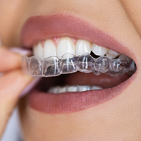 Clear Aligners